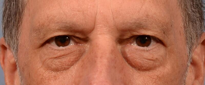 Blepharoplasty