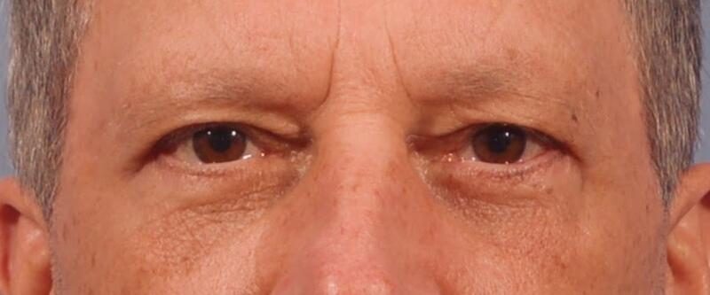 Blepharoplasty