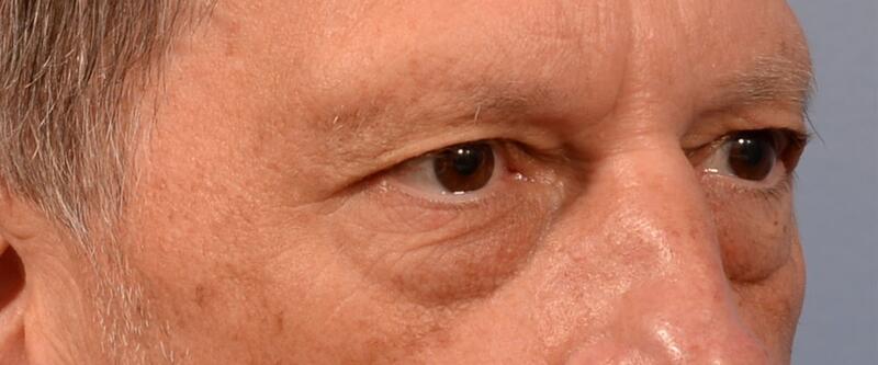 Blepharoplasty