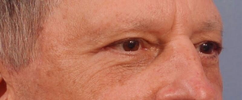 Blepharoplasty