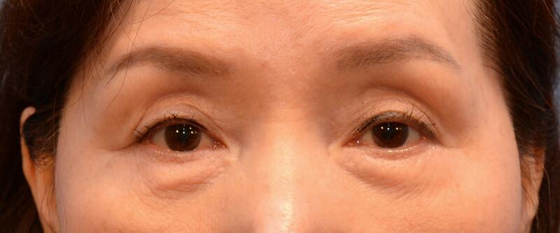 Blepharoplasty