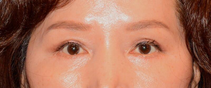 Blepharoplasty