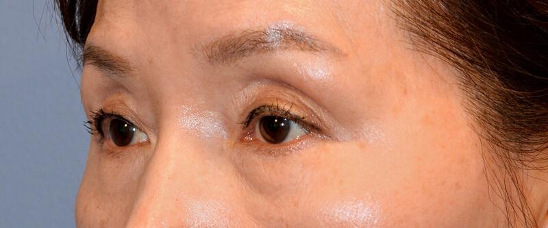 Blepharoplasty