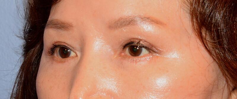 Blepharoplasty