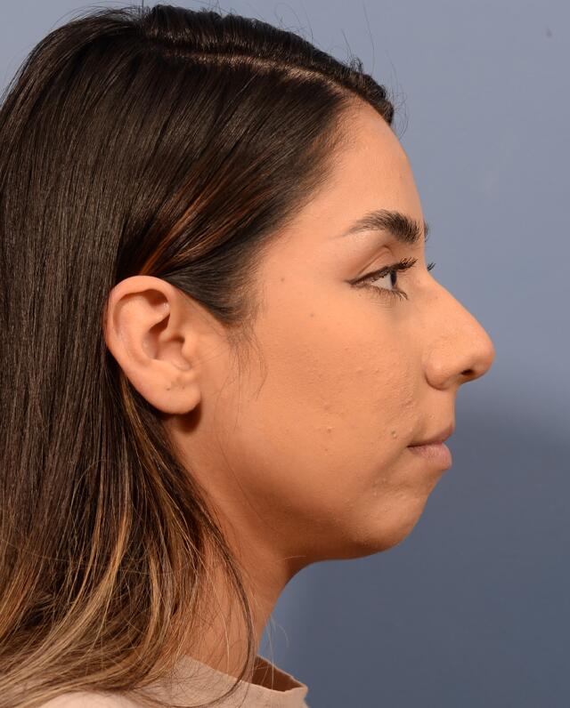 Chin Augmentation