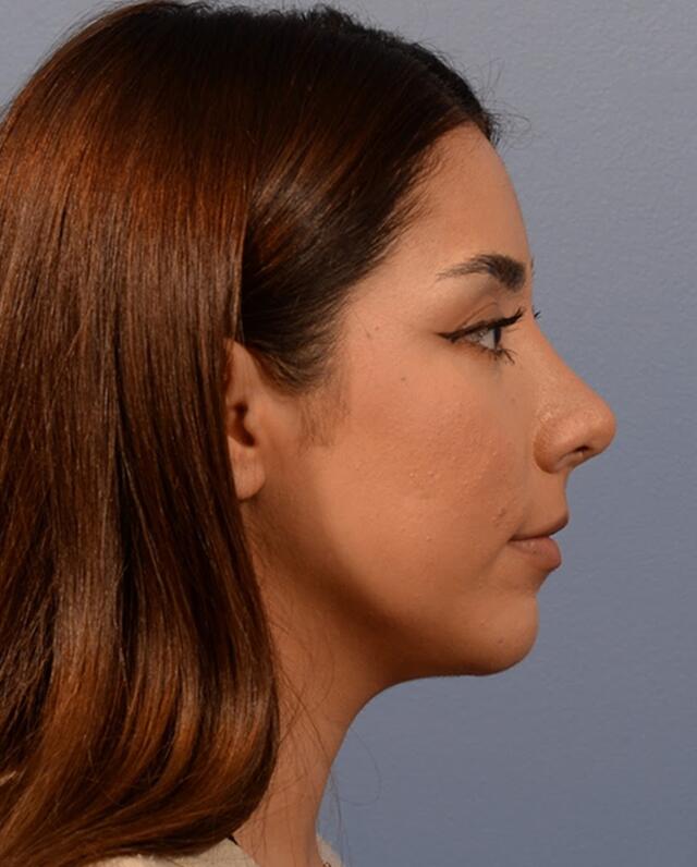 Chin Augmentation