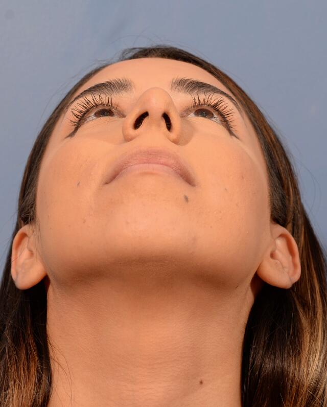 Chin Augmentation