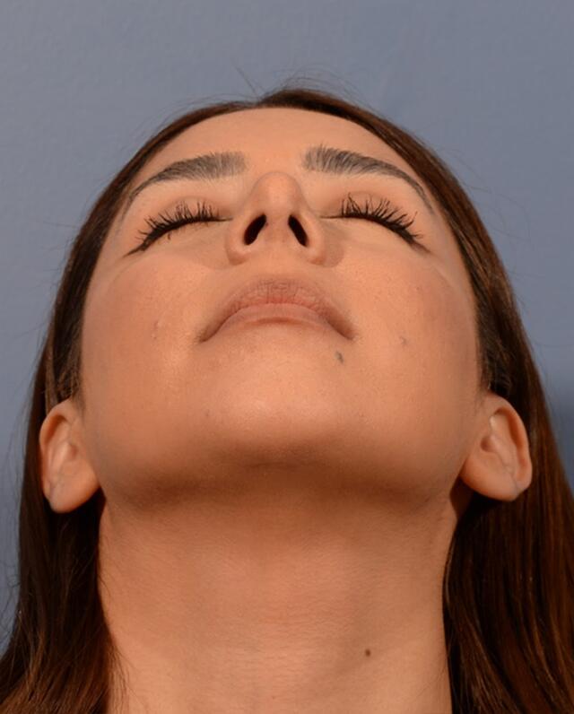 Chin Augmentation