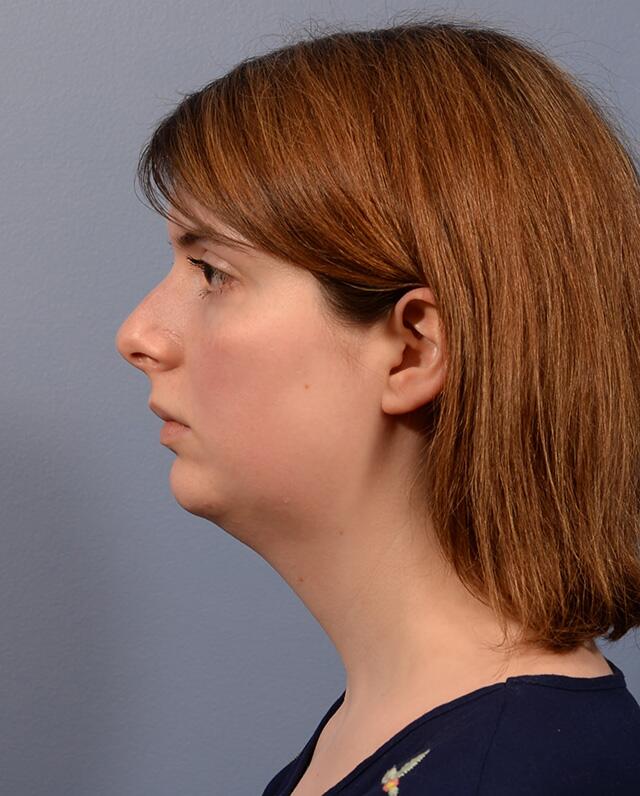 Chin Augmentation