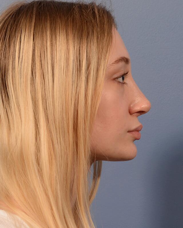 Rhinoplasty