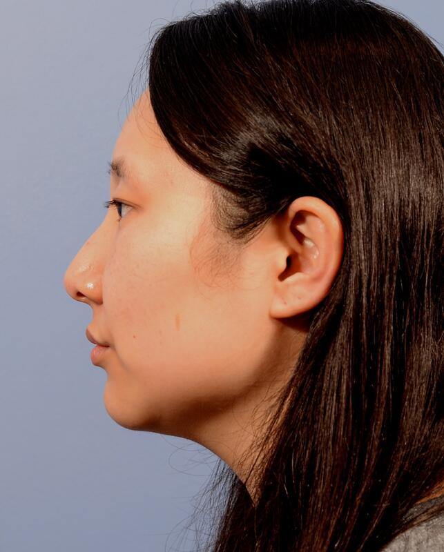 Rhinoplasty