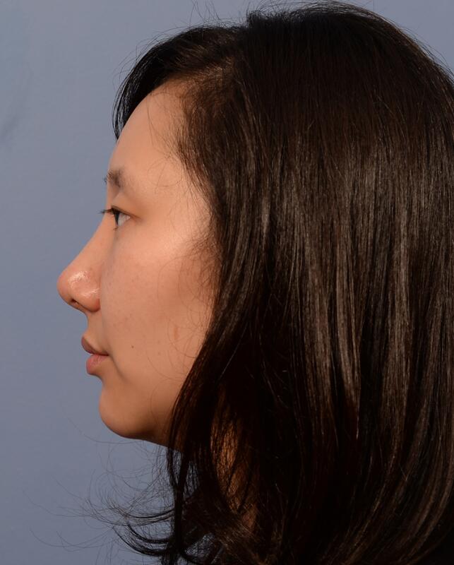 Rhinoplasty