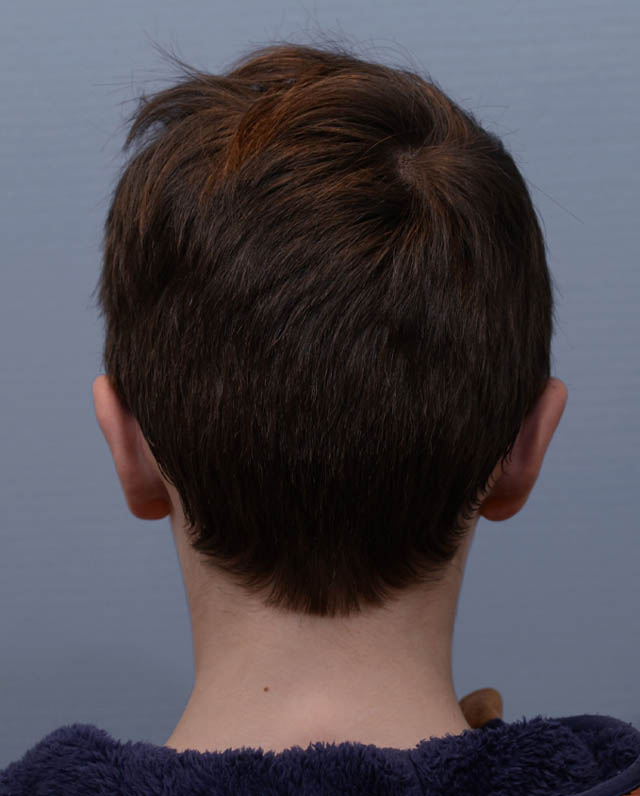 Otoplasty