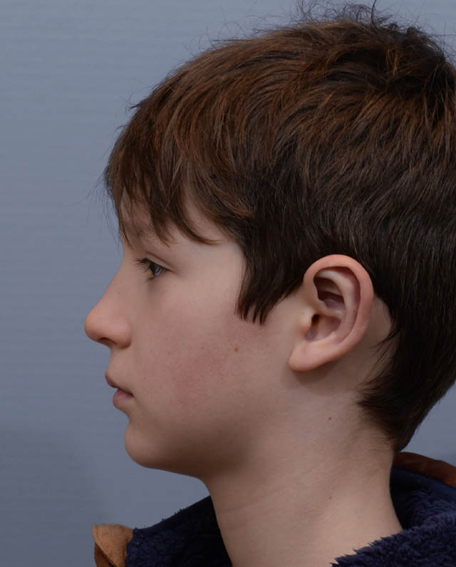 Otoplasty