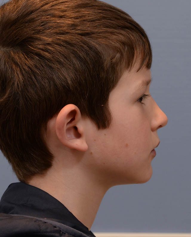 Otoplasty