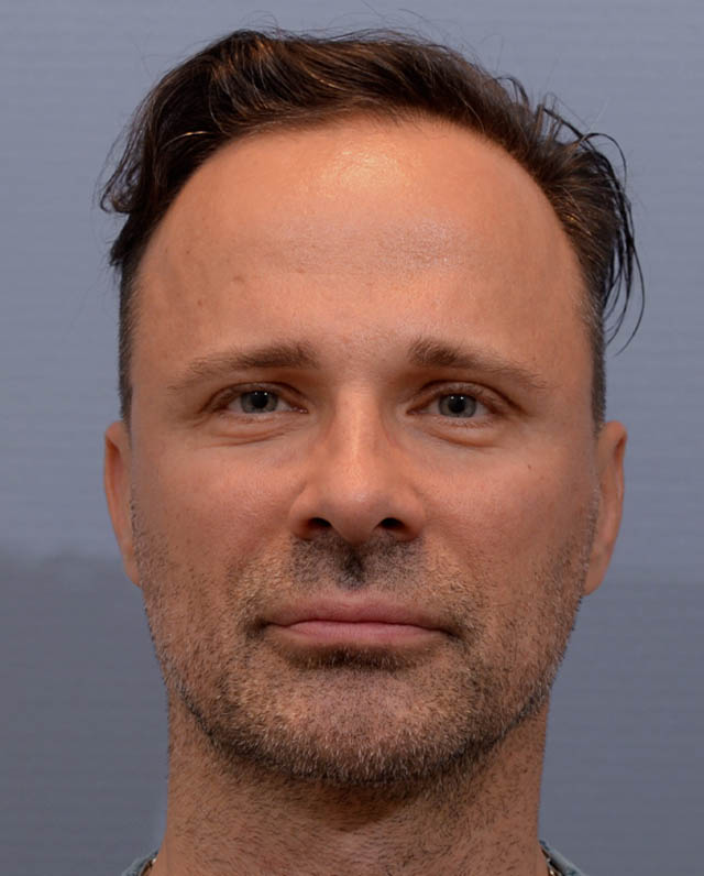 Chin Augmentation