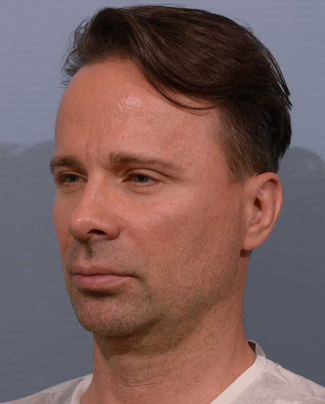 Chin Augmentation