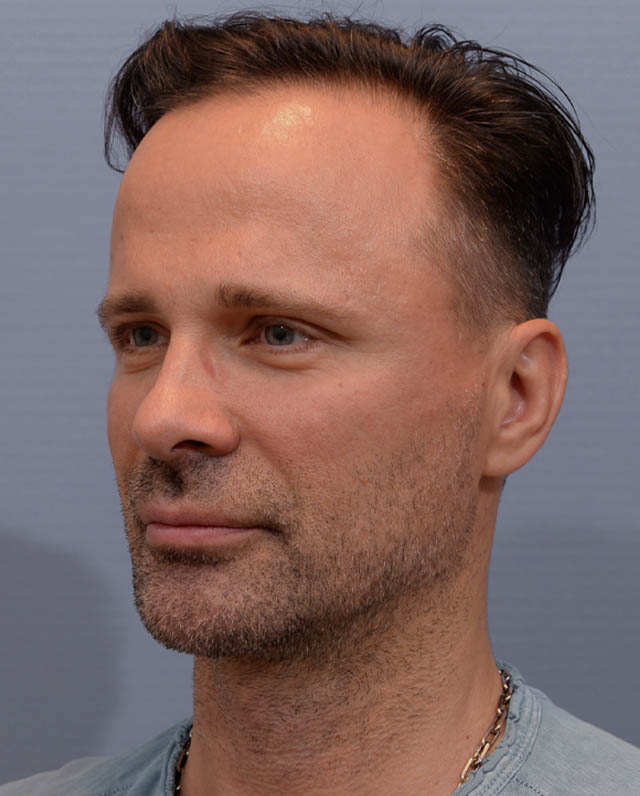 Chin Augmentation