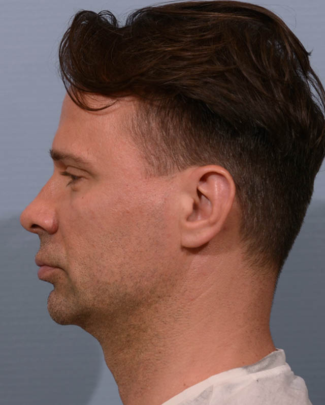 Chin Augmentation