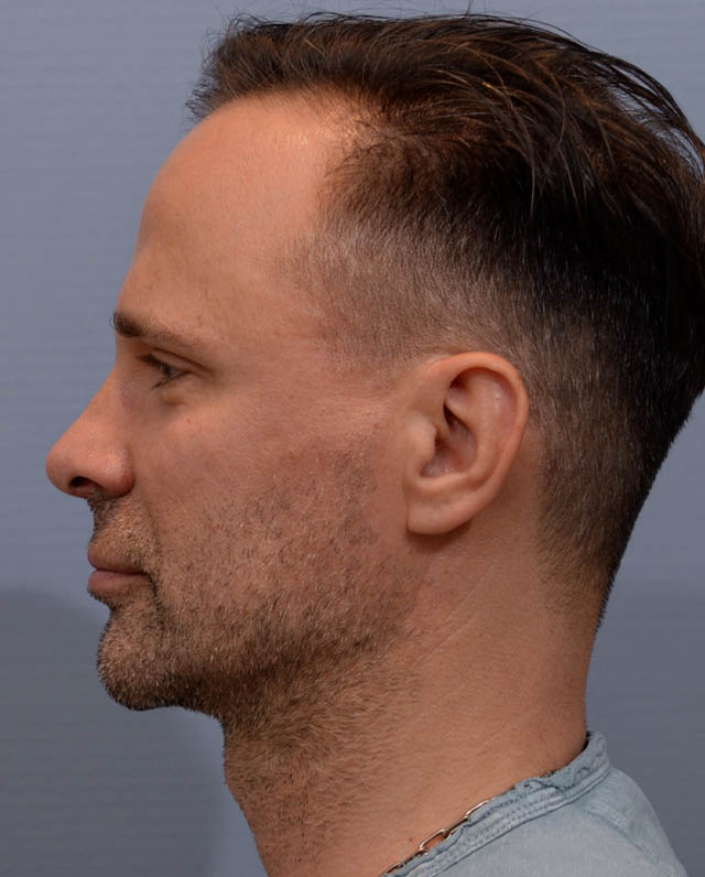 Chin Augmentation