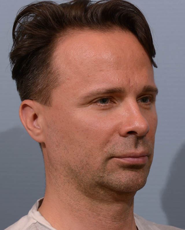 Chin Augmentation