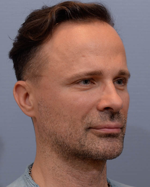 Chin Augmentation