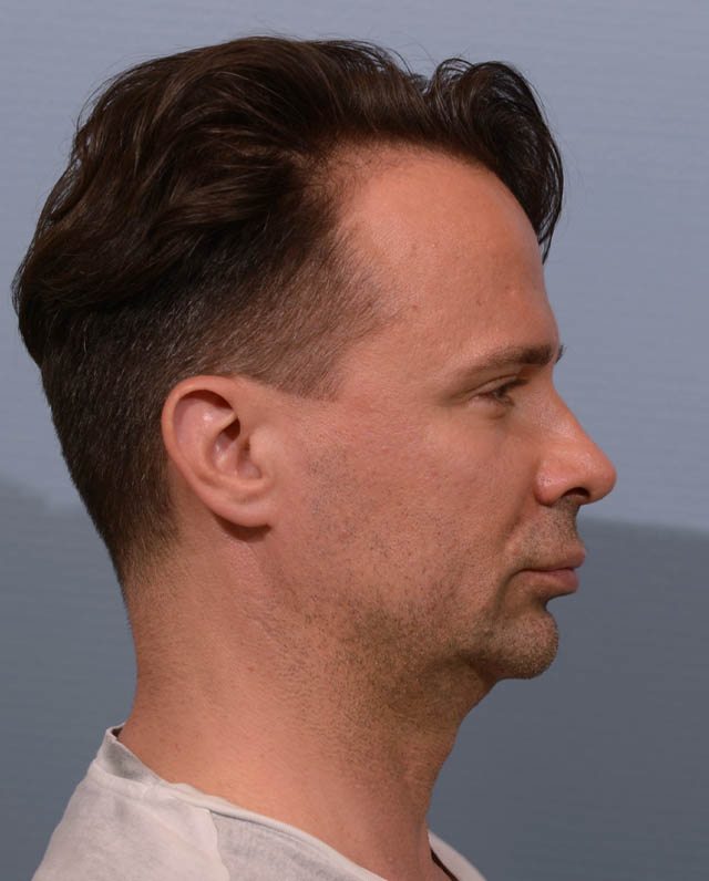 Chin Augmentation