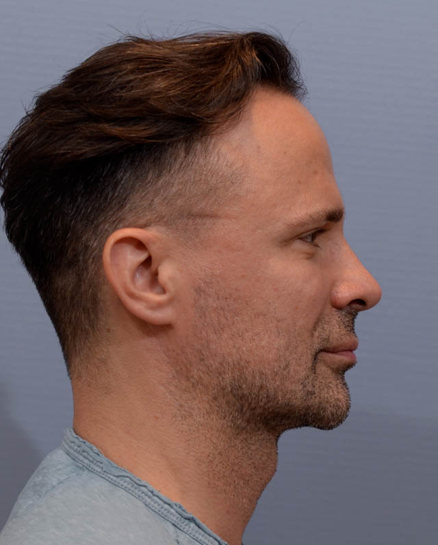 Chin Augmentation